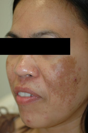 Melasma Treatment Before and After Photos before 641757
