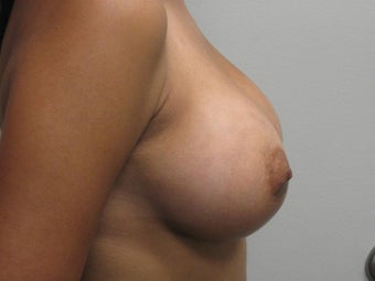 Breast Augmentation 382786