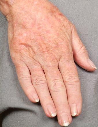 Radiesse treatment for hand rejuvenation after 124648