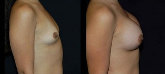 Breast Implants 150821