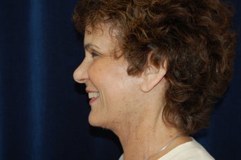 Facelift 336453