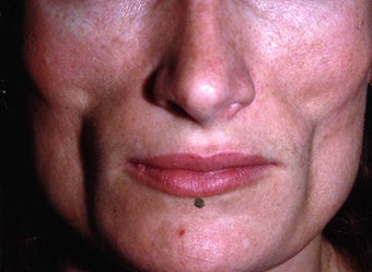 Facial Volumizing with Fillers before 149191
