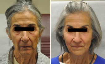Facial Fillers + Chemical Brow Lift before 529796