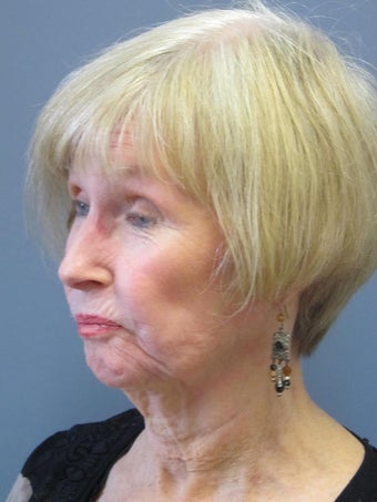 Neck Lift, Platysmaplasty 634745