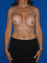 Revisionary Breast Surgery (Internal Sutures for pocket repair) before 123396