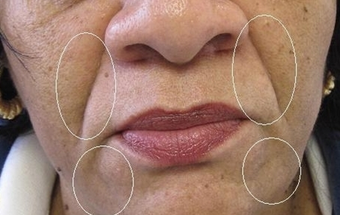 Restylane Injection Nasolabila folds before 387849