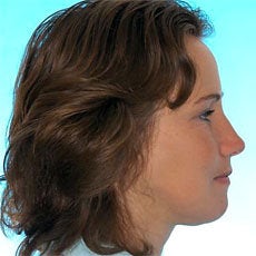 Orthognathic Jaw Surgery after 510584