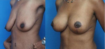 Breast Lift with Implants before 134093
