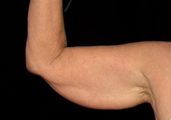 Arm Lift before 230667