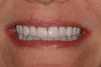 Smile Makeover after 231519