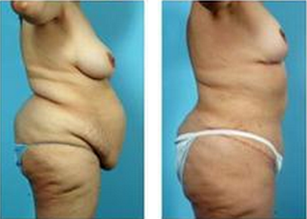 Mommy Makeover 325020