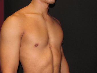 Pectoral Implants 421489