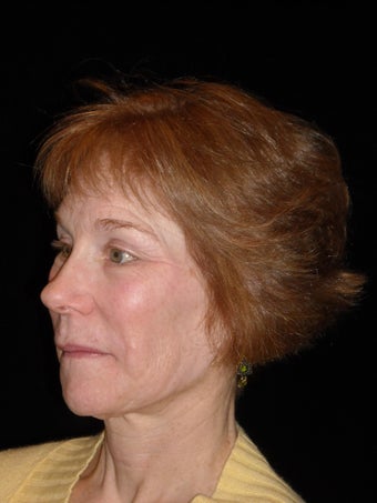 Midface lift with Endotine fixation device after 225077