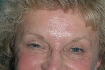 Crowsfeet treated with Botox Cosmetic before 118313