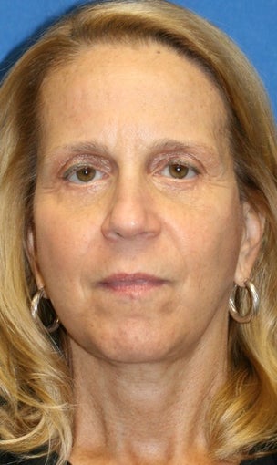 5 months post-op: Facelift, Necklift, Full Face Fat Transfer, and Lower Eyelid Skin Pinch after 385690