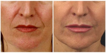 Restylane before 336761