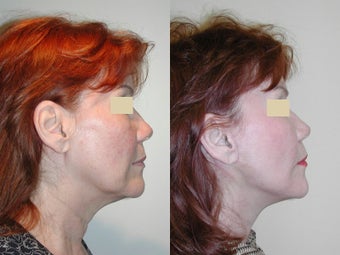 Mini jowl and neck lift - SLUPlift before 136277