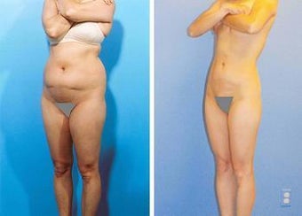 Liposuction before 636228