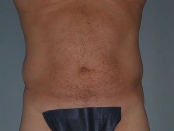 Liposuction after 581438