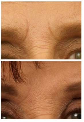 Restylane before 327286