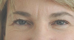 Botox forehead lines (frown lines) before 91313
