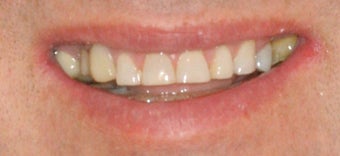 Porcelain veneers and crowns before 503136