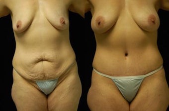 Tummy Tuck and Breast Augmentation, gel implants before 392054