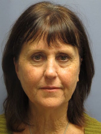 Neck Lift, Platysmaplasty before 634720