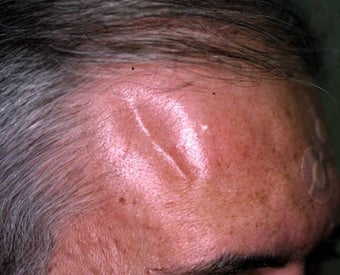 Liquid Injectable Silicone before 149190