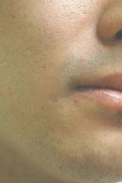 Laser Scar Removal Los Angeles after 145654