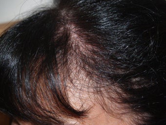 Hair Transplant into Scar 336980