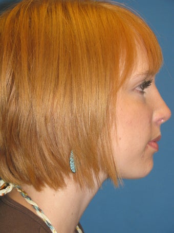 Rhinoplasty after 223693