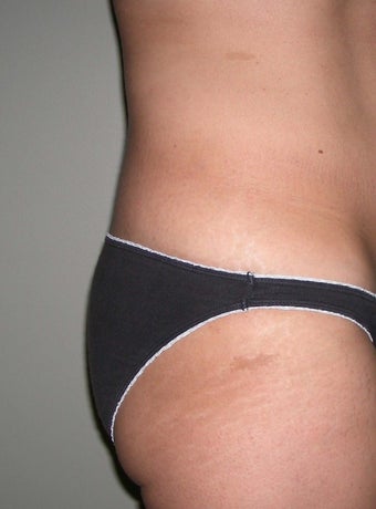 Butt implant augmentation before 266045