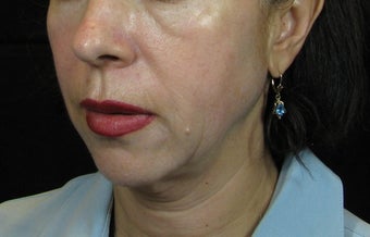Facelift before 246964