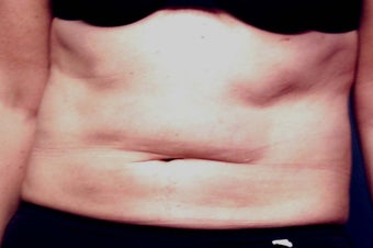 Slim Lipo before 137499