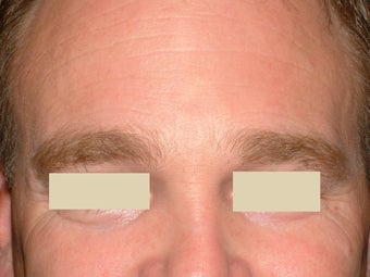 Botox after 93219