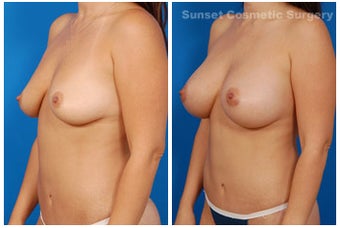 Mommy Makeover: Breast Implants & Tummy Tuck after 255534