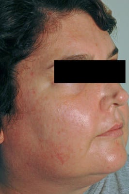 Laser Acne Treatment after 82969
