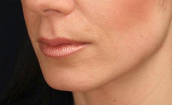 Lip augmentation after 393215