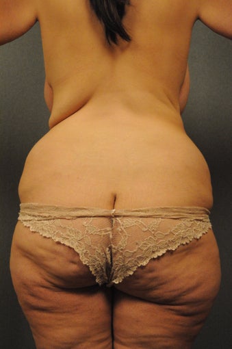 Abdominoplasty, abdominal and flank liposuction, beltlipectomy, bilateral mastopexy 366885