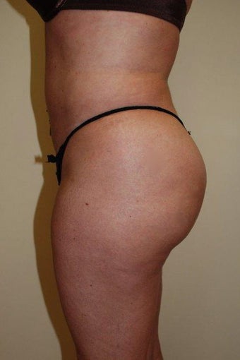 Buttock Augmentation 516167