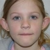 Otoplasty before 443057