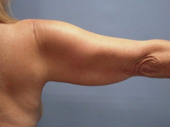 Liposuction before 581446