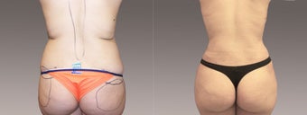 Fat Transfer/Buttock Reshaping before 395839