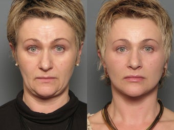 Facelift before 338469