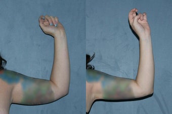 Liposuction - Upper Arms before 130841