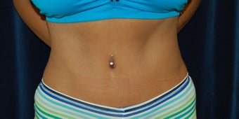 Abdominoplasty after 361995
