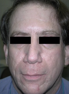 Silicone Microdroplet Therapy for Acne Scars before 334060
