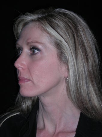 Filler injection perioral area before 226708