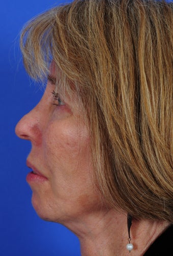 Face Lift 322007